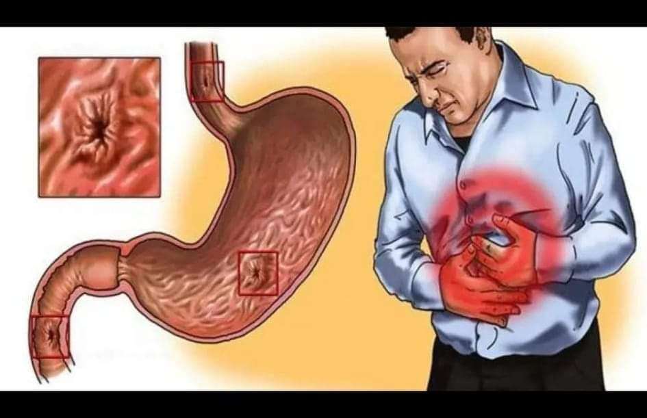 تحليل جرثومة المعده في البراز