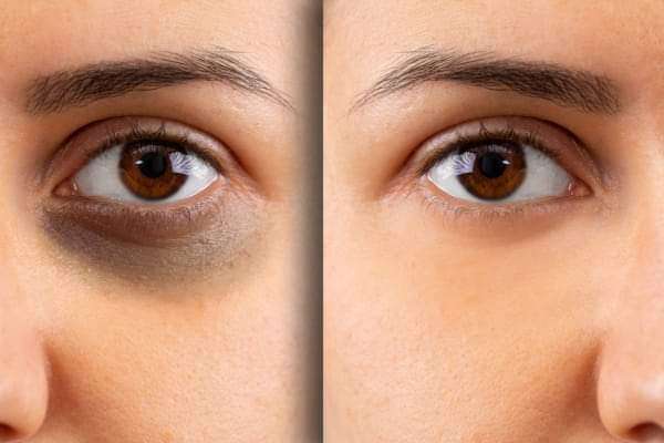 جل لعلاج  الهالات السوداء بالهايلورنيك والكولاجين