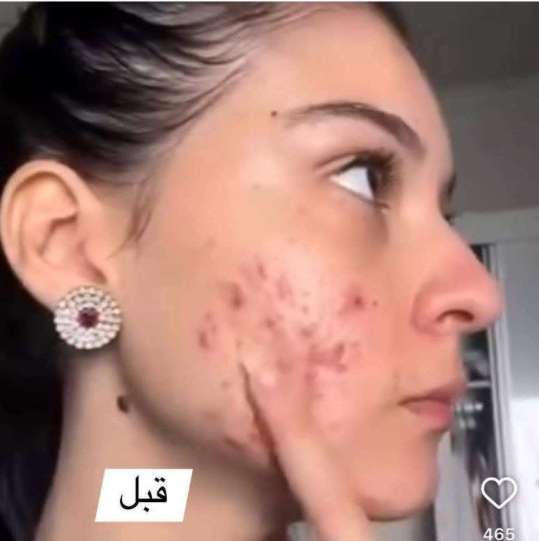 بانوكسيل