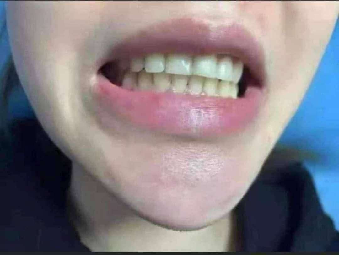 مبيض الاسنان