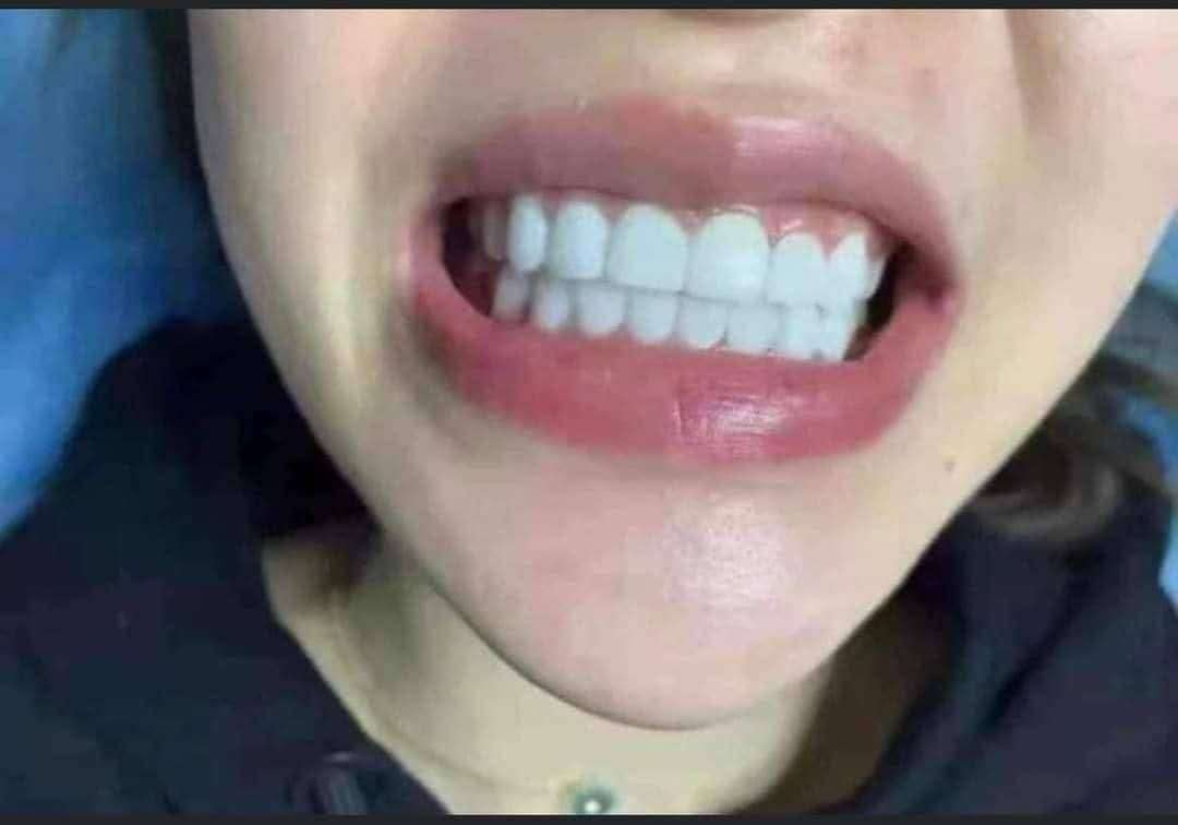 مبيض الاسنان
